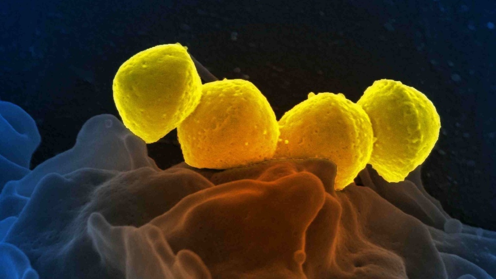 An electron micrograph of Group A Streptococcus (Streptococcus pyogenes) bacteria on primary human neutrophil. (BSIP/Universal Images Group/Getty Images via CNN Newsource)