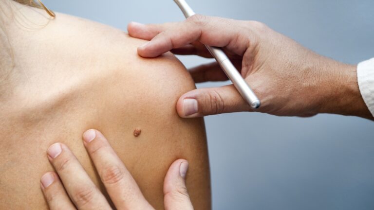 « Le processus de triage peut-il être meilleur ? » : une étude d'Halifax examine les moyens de diagnostiquer et de traiter les cancers de la peau plus rapidement
