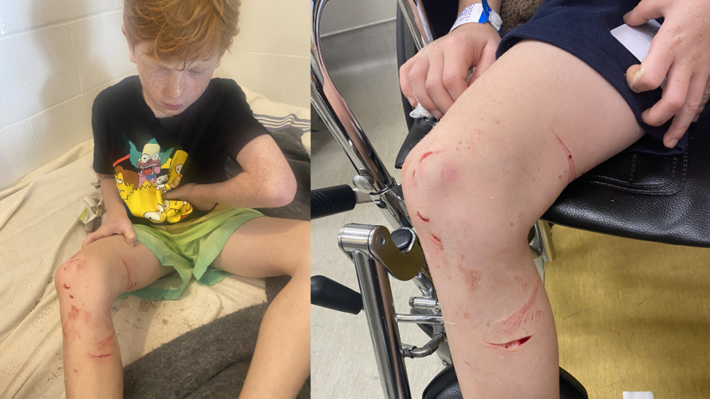 Un garçon de huit ans retrouvé couvert de sang après une morsure sur une plage de Montréal