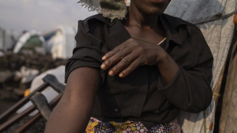 Maintenant que le mpox est une urgence sanitaire mondiale, va-t-il déclencher une autre pandémie ?