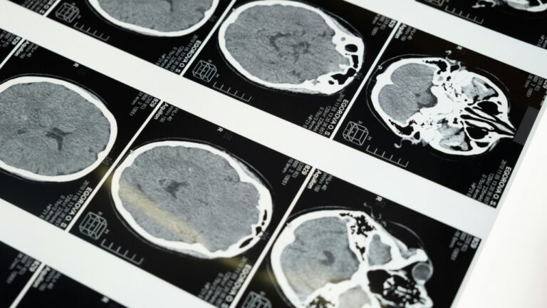 FILE - Images from a brain scan are displayed. (Pexels)