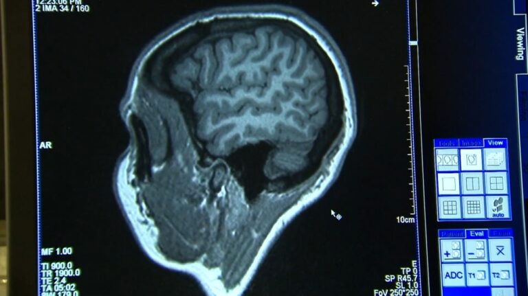 Santé NB est au courant de 263 cas possibles de maladies neurologiques, mais affirme que la plupart n'ont pas été correctement soumis