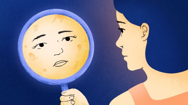 Dermatologists cast doubt on chatter among social media users that high levels of the stress hormone cortisol can lead to puffy or rounded cheeks, a condition that’s been dubbed “moon face.” (Yukari Schrickel/CNN via CNN Newsource)