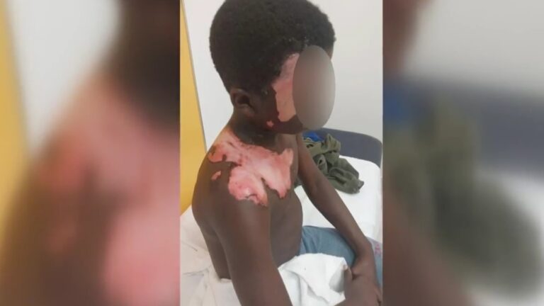 Une Longueuilienne accusée après qu'un garçon de 10 ans ait été ébouillanté avec de l'eau bouillante