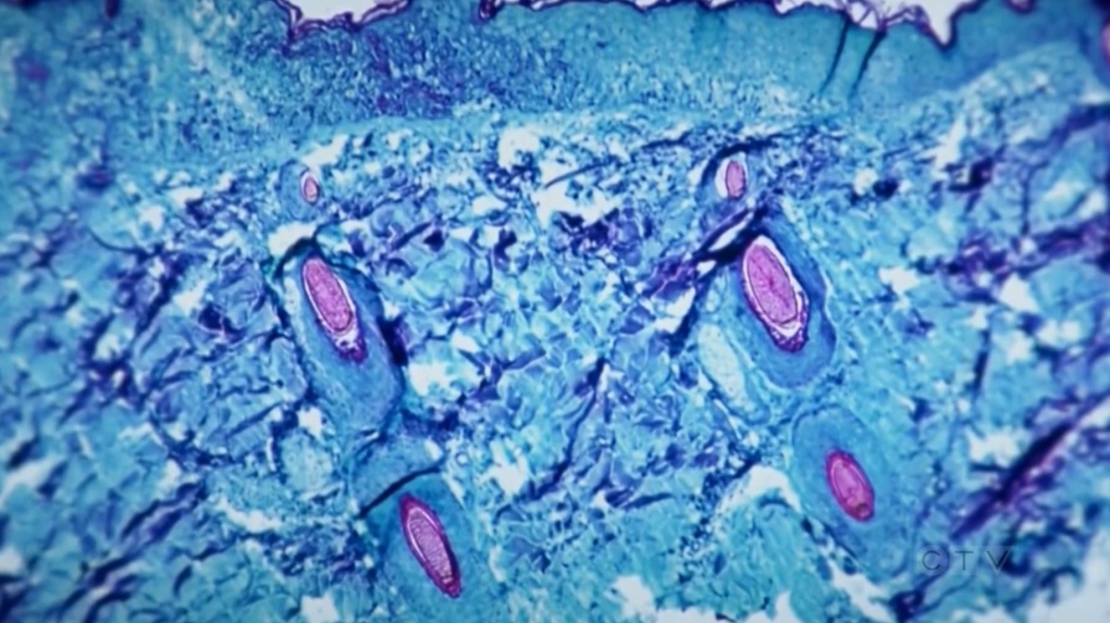 Le Manitoba signale le premier cas de mpox, la province affirme que le risque pour le public est faible
