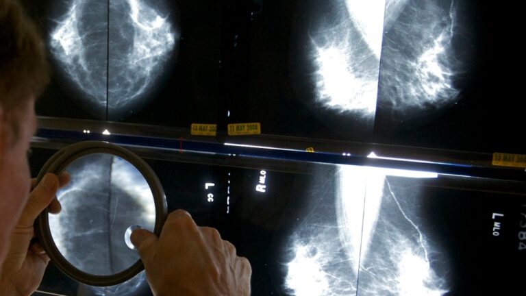 Certaines patientes atteintes d'un cancer du sein peuvent éviter certaines interventions chirurgicales, suggèrent des études