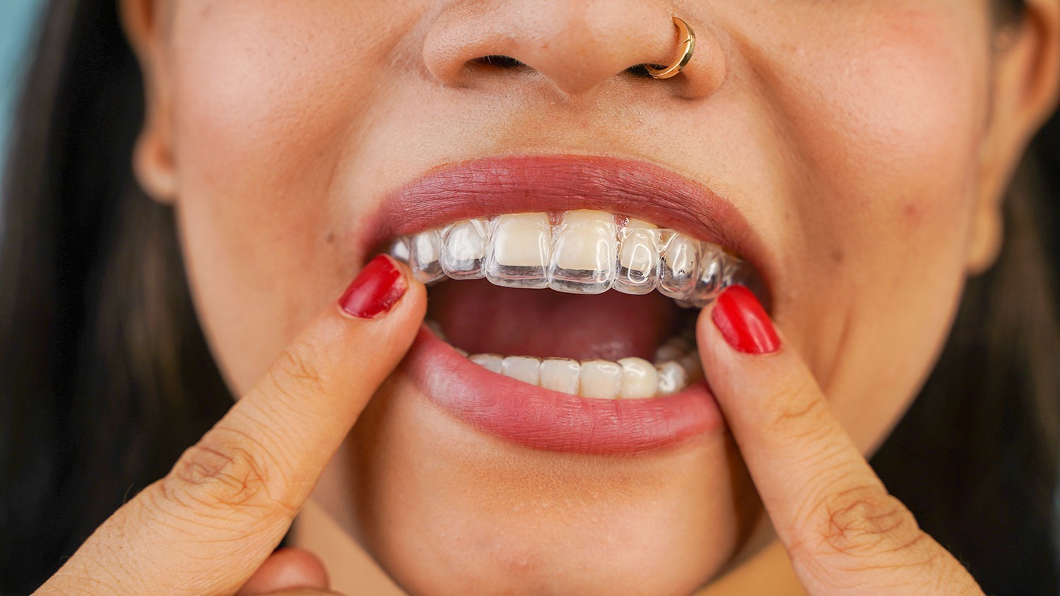 Orthodontie au Canada : comprendre le traitement orthodontique et ses enjeux